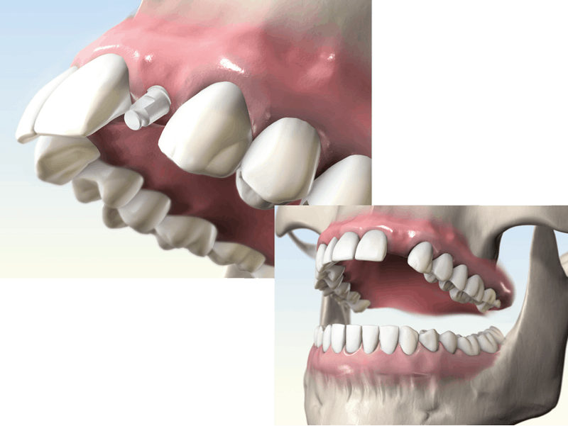 whiteSKY - The metal free implant | bredent-implants