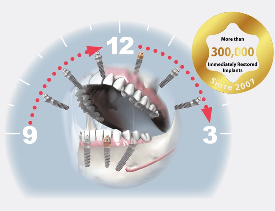 SKY fast & fixed treatment | bredent-implants